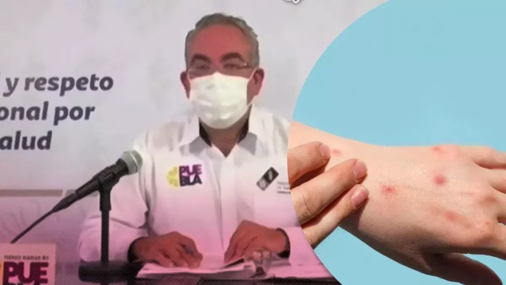 Viruela del mono llega a Puebla: confirman dos casos positivos.