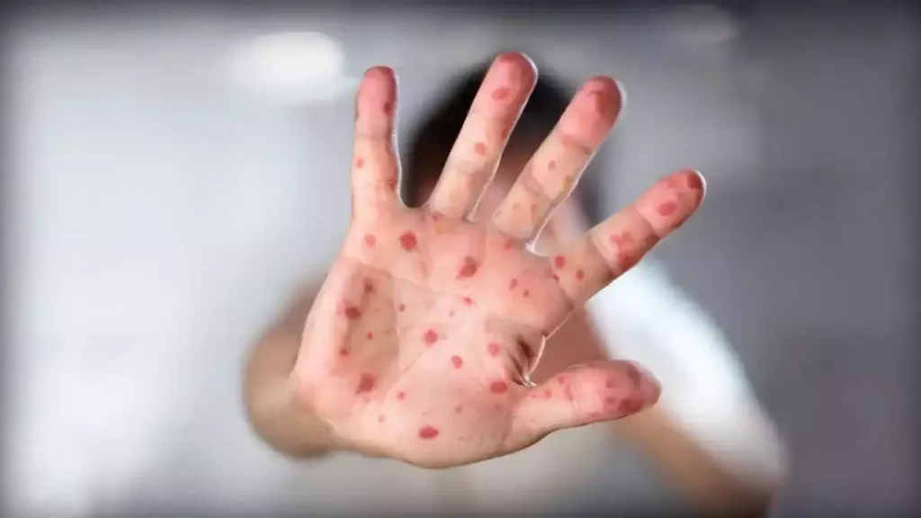 En dos meses se han registrado 10 casos de viruela símica en Puebla.