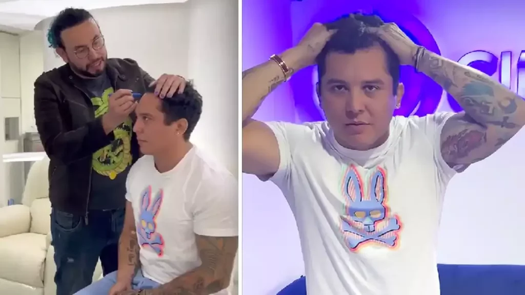 Edwin Luna no quiere verse pelón; se somete a un injerto de cabello.