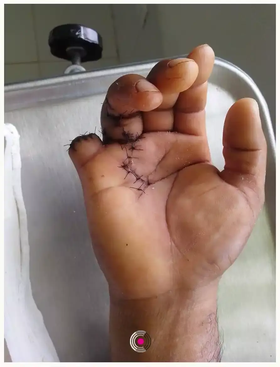 Le mutilan una mano en Pantepec; Fiscalía le niega acceso a la justicia