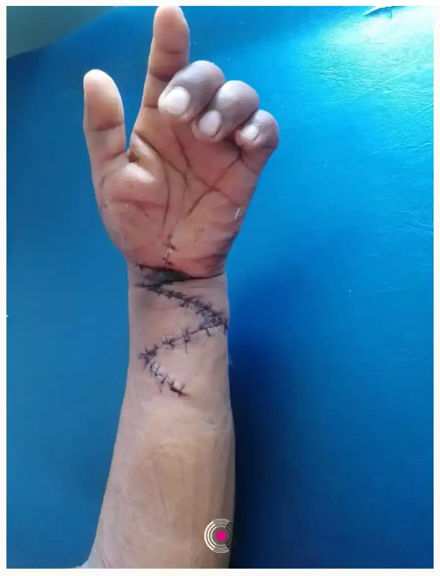 Le mutilan una mano en Pantepec; Fiscalía le niega acceso a la justicia