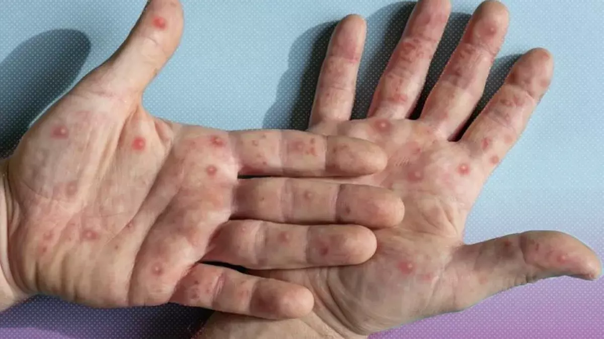 Puebla suma 20 casos acumulados de viruela símica desde junio