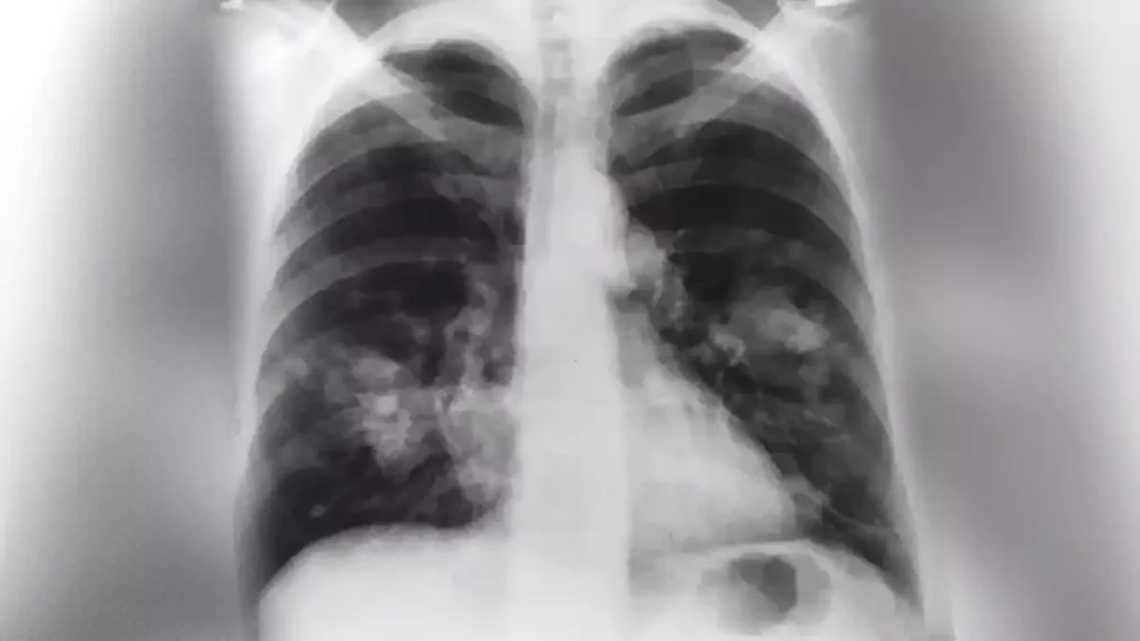 De los tipos de cáncer, el de pulmón causa mayor mortalidad en Puebla