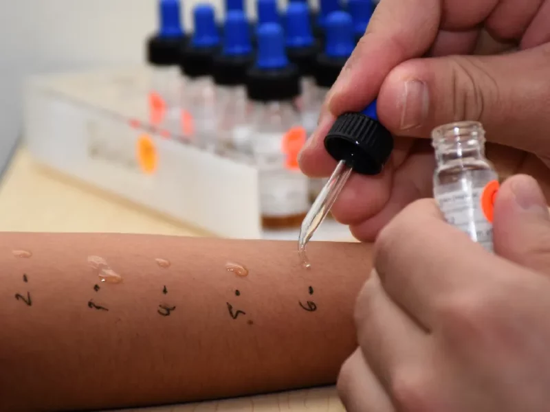 El Servicio de Alergia e Inmunología Clínica del HUP realiza estudios sobre sensibilidad de vacunas contra SARS-CoV-2 en pacientes con alergia