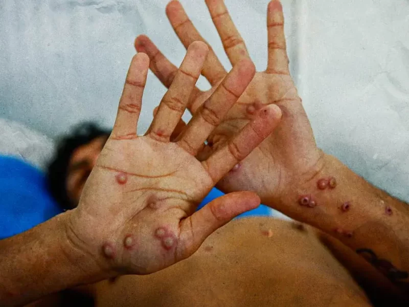 Por segunda ocasión, OMS declara viruela del mono amenaza sanitaria internacional