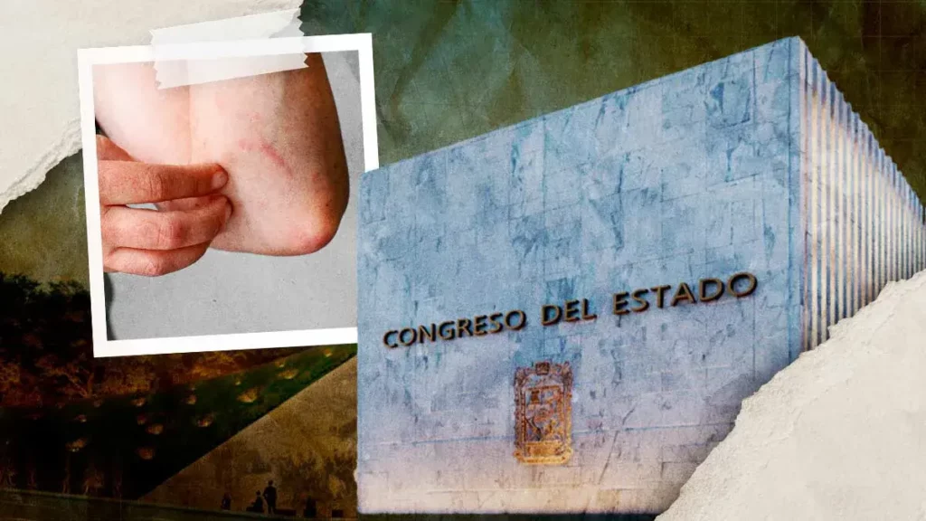 Congreso de Puebla propone "Ley Lupus" para garantizar atención y tratamiento a pacientes con enfermedades autoinmunes