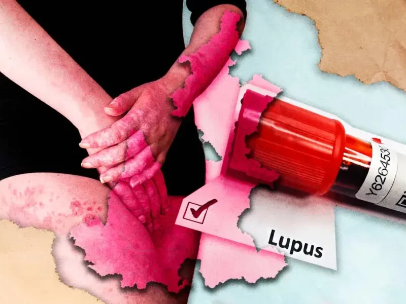 Colectivo tiene registradas a 218 personas con Lupus en Puebla; 198 son mujeres