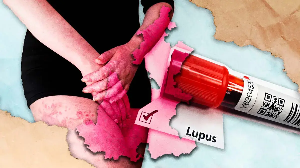 Colectivo tiene registradas a 218 personas con Lupus en Puebla; 198 son mujeres