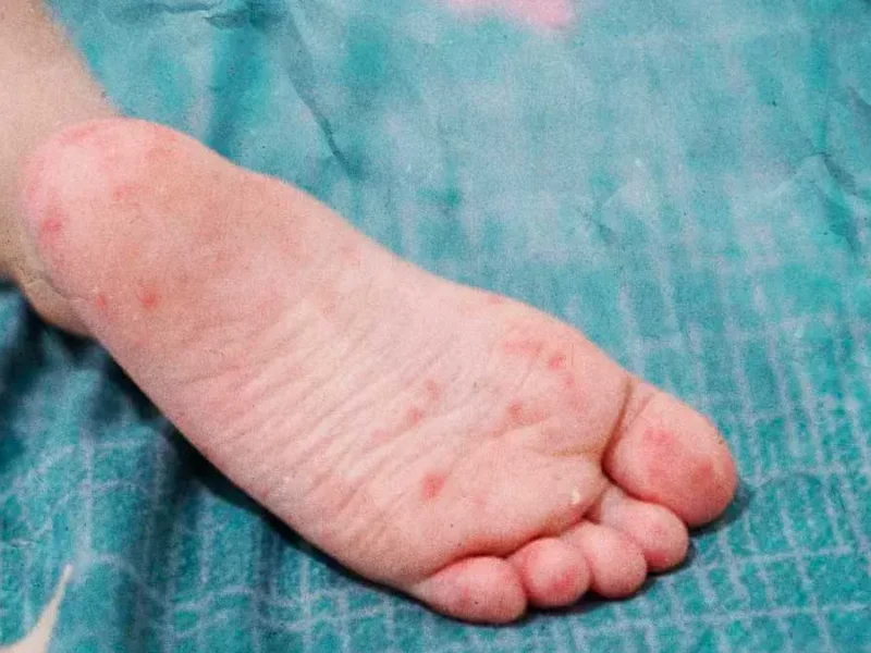 Casos de Coxsackie disminuyen 32% en menores de Puebla; persiste en Zona Metropolitana e Izúcar