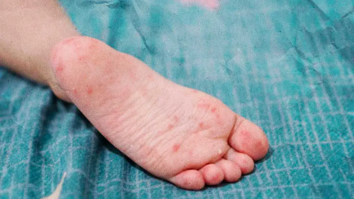 Casos de Coxsackie disminuyen 32% en menores de Puebla; persiste en Zona Metropolitana e Izúcar