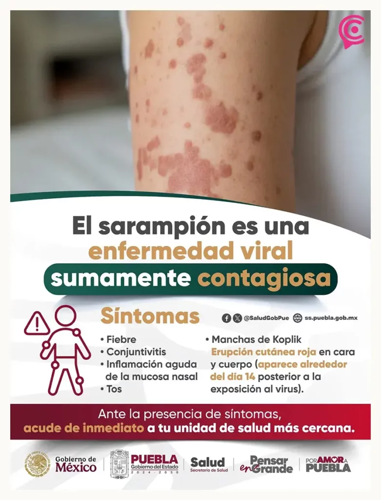 Exhorta gobierno de Texmelucan a reforzar medidas sanitarias ante brotes de sarampión en el estado