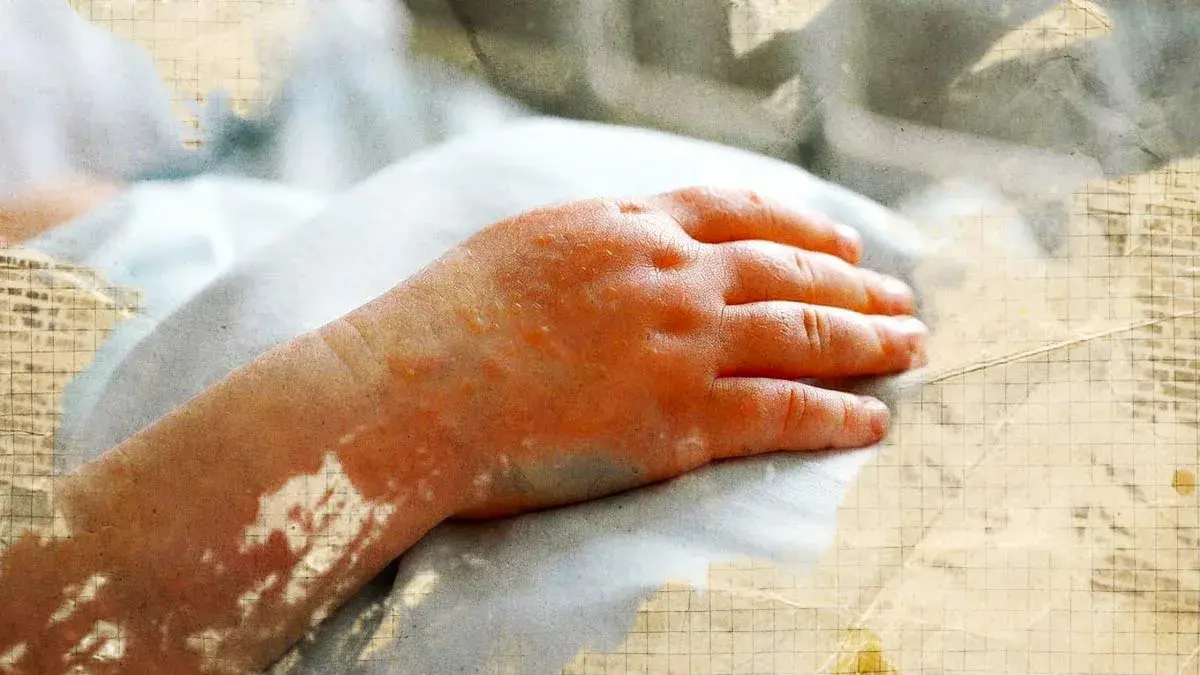Niño de Puebla murió por sarampión en Tlaxcala; automedicado por familia y sin vacunas