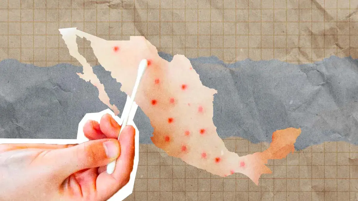 Brote de sarampión en México deja 28 muertes y nueve mil contagios confirmados en 2025-2026