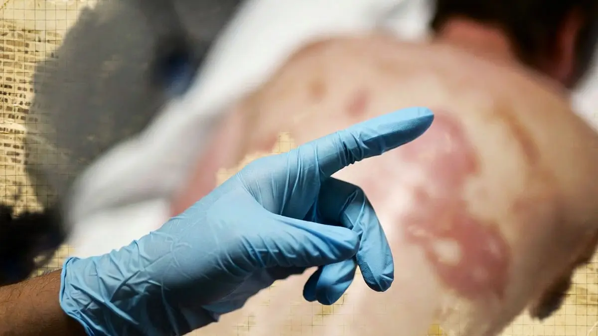 Estados de México emiten alertas sanitarias por sarampión; autoridades sanitarias comparten recomendaciones para evitar contagios