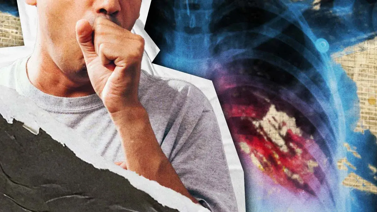Puebla reporta 83 casos de tuberculosis en lo que va de 2026