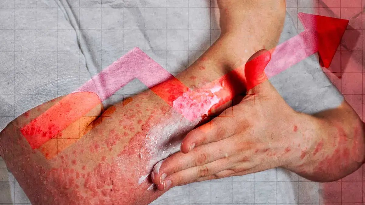 Aumentan casos de sarampión en Puebla; suman 196 al 25 de marzo de 2026