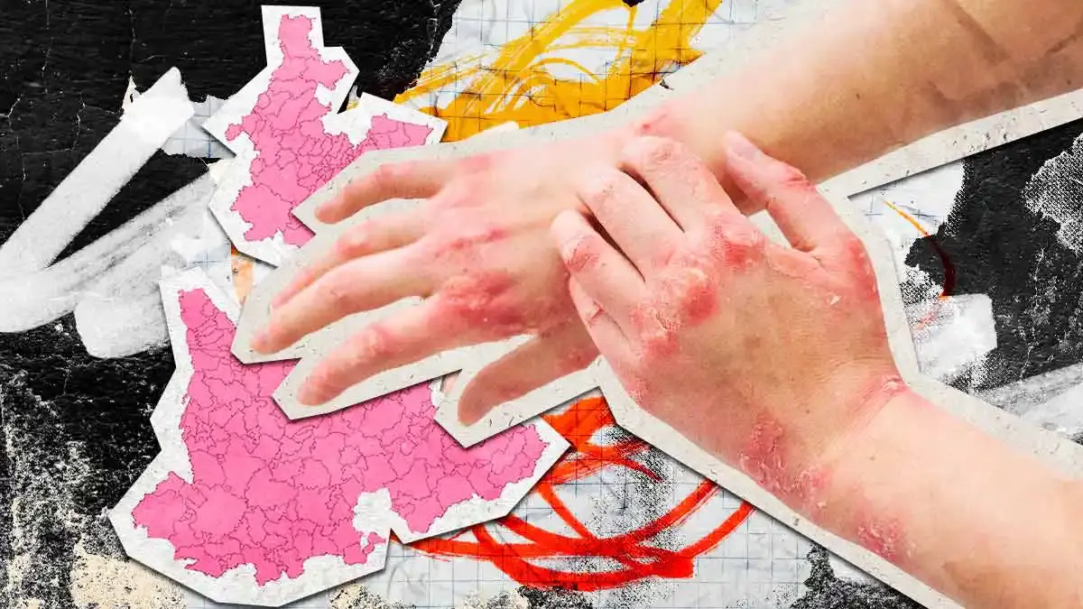 Cada cuatro horas una persona sufre quemaduras en Puebla; primer trimestre 2026 acumula 452 casos