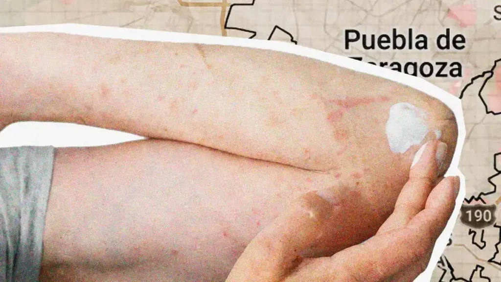 Puebla acumula 215 casos de sarampión al 24 de abril de 2026
