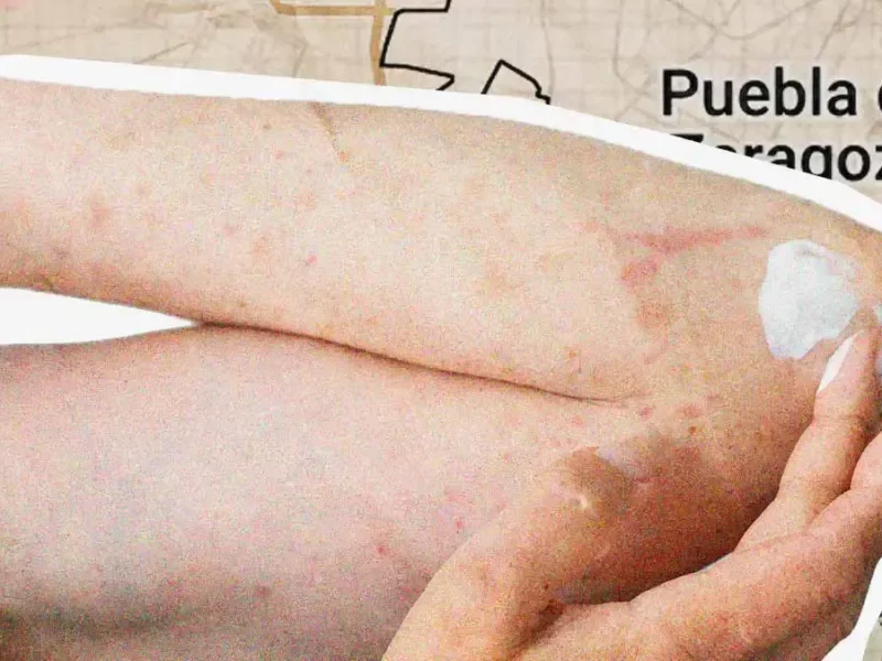 Puebla acumula 215 casos de sarampión al 24 de abril de 2026