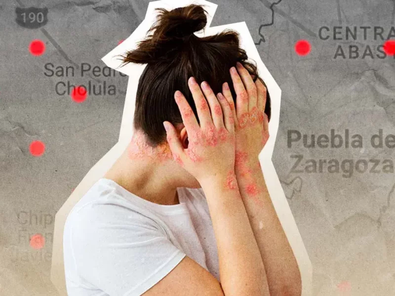 Puebla acumula 219 casos de sarampión al 1 de mayo de 2026