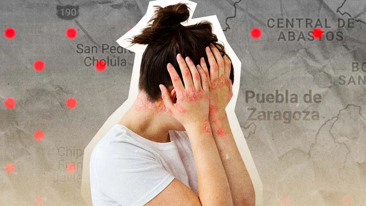 Puebla acumula 219 casos de sarampión al 1 de mayo de 2026