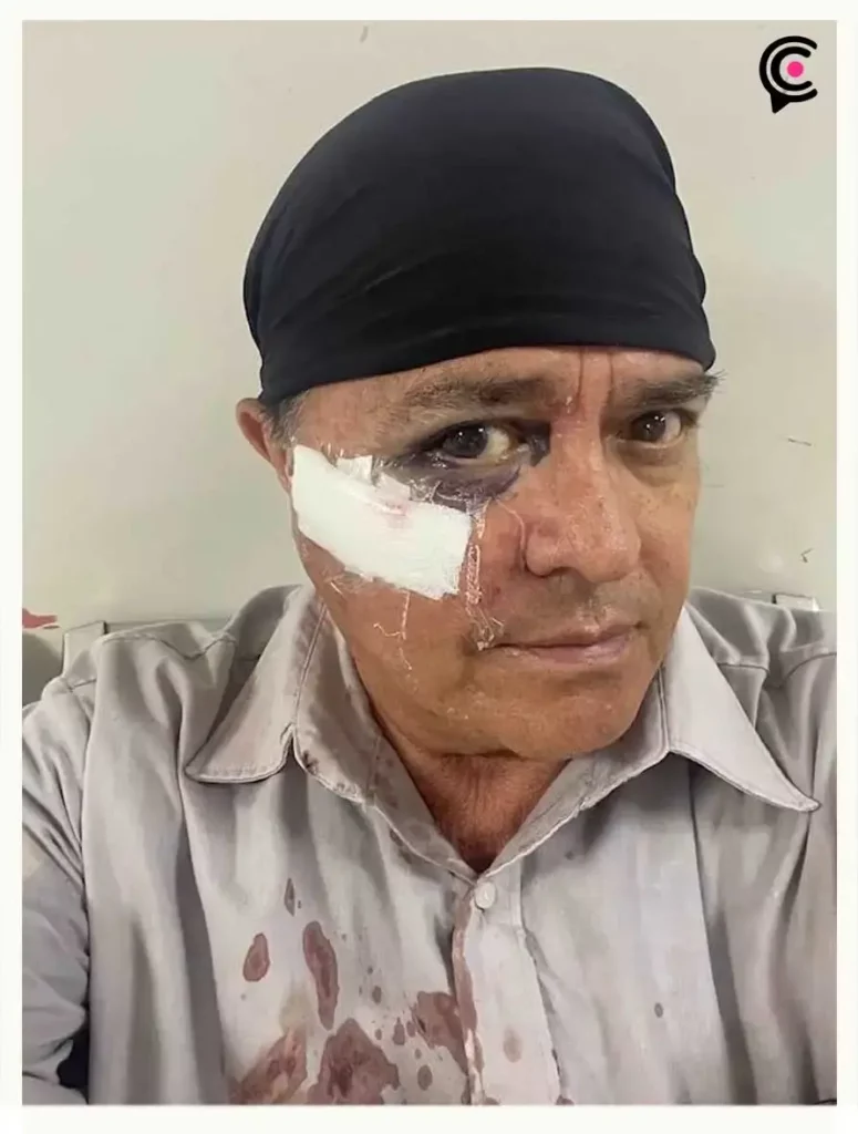 Atacan con clavo en el ojo a fotoperiodista de NatGeo camino al Fan Fest CDMX antes del México-Inglaterra